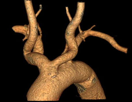 118519_变异的主动脉弓part-1（aortic arch）