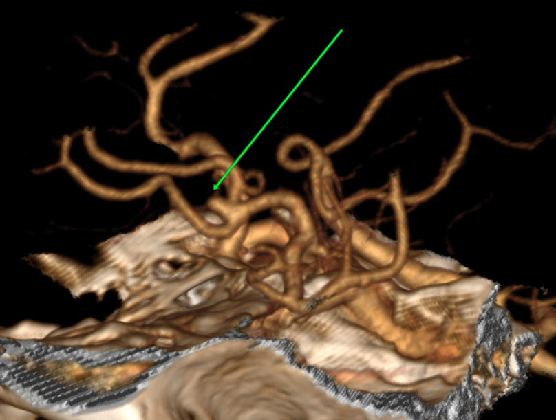 118519-颅内动脉瘤部分-part2 （ACoA AN， AChA  AN）