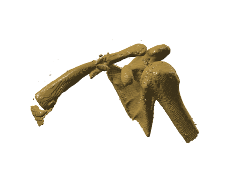 121001_左侧锁骨中段骨折模型