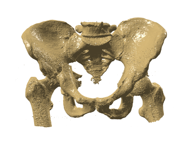 128523_右侧髋关节骨折模型