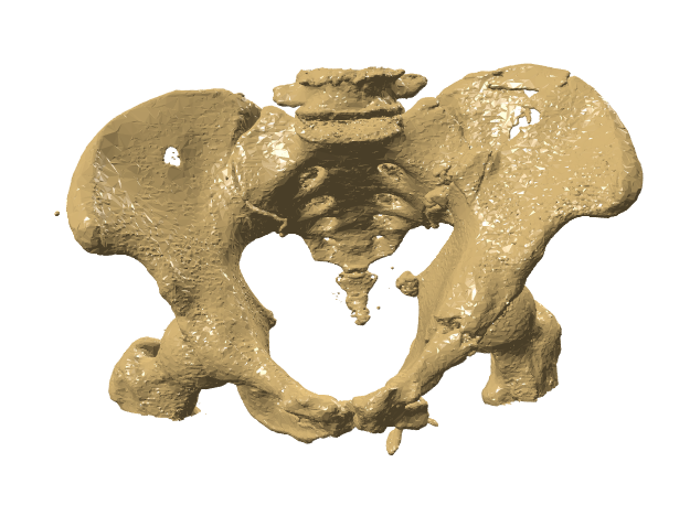 128803_左侧髂骨骨折模型