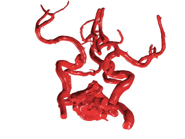 颅内多发动脉瘤模型