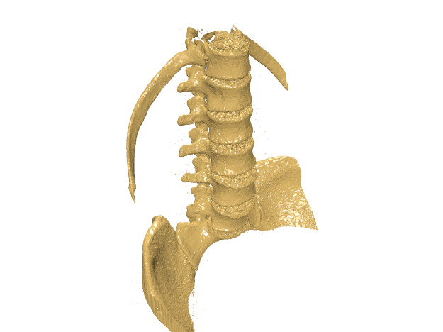 腰椎骨质重建-750742