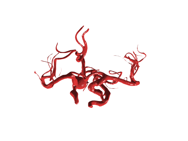 右侧颈内动脉后交通段巨大动脉瘤